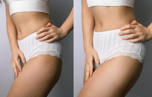 MCA Scar Treatment